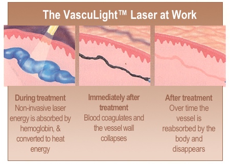 The VascuLight Laser at work