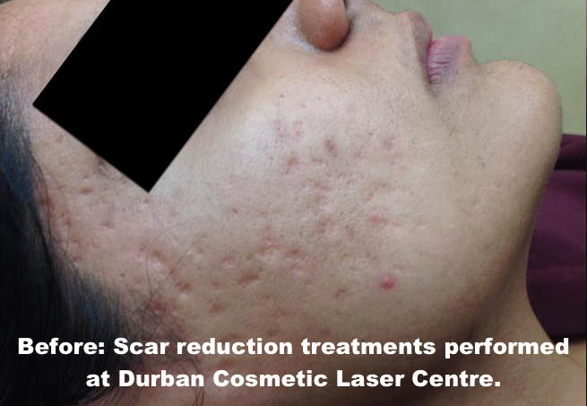 scar reduction before